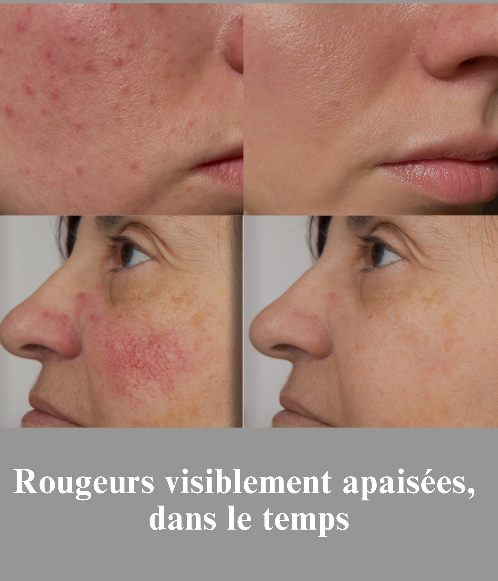 Protocole In & Out Anti-Rougeurs