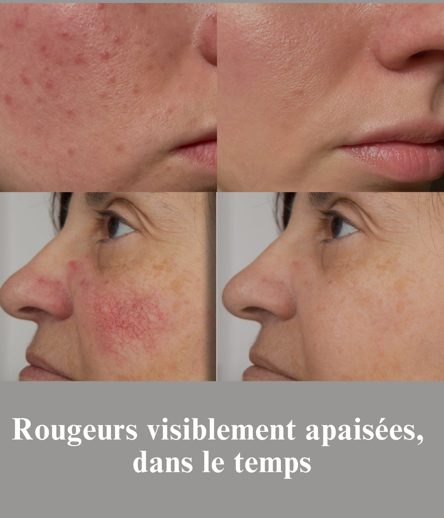 Pack Rougeurs Persistantes